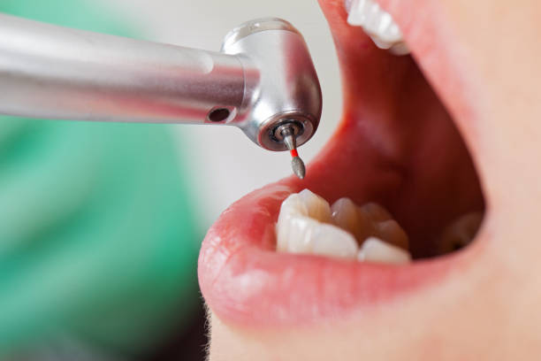 Best Emergency Dental Care for Broken or Chipped Teeth in Chackbay, LA